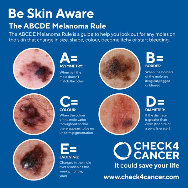 ABCDE Skin Cancer Rule