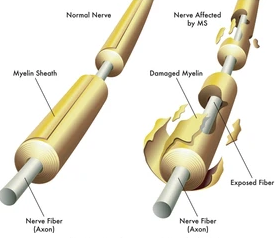 Demyelination